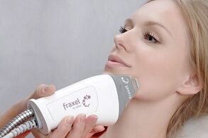 la esencia del procedimiento fraccional de rejuvenecimiento de la piel del rostro